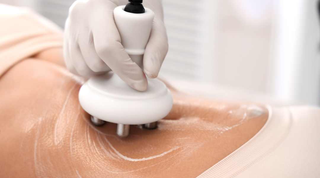 Estética corporal en Hudson: tecnología avanzada para moldear tu cuerpo sin cirugía